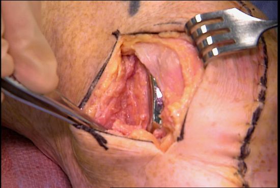 Video:  Polyaxial Locked-Plate Fixation of Periarticular Fractures of the Knee by George Haidukewych